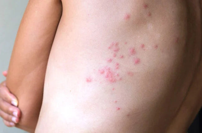 Pico X Bed Bug Tips